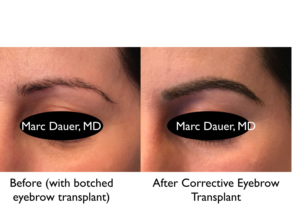 Eyebrow Transplant Photos Los Angeles Eyebrow Transplantation