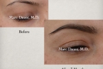 eyebrow transplant photo eyebrow transplant photo