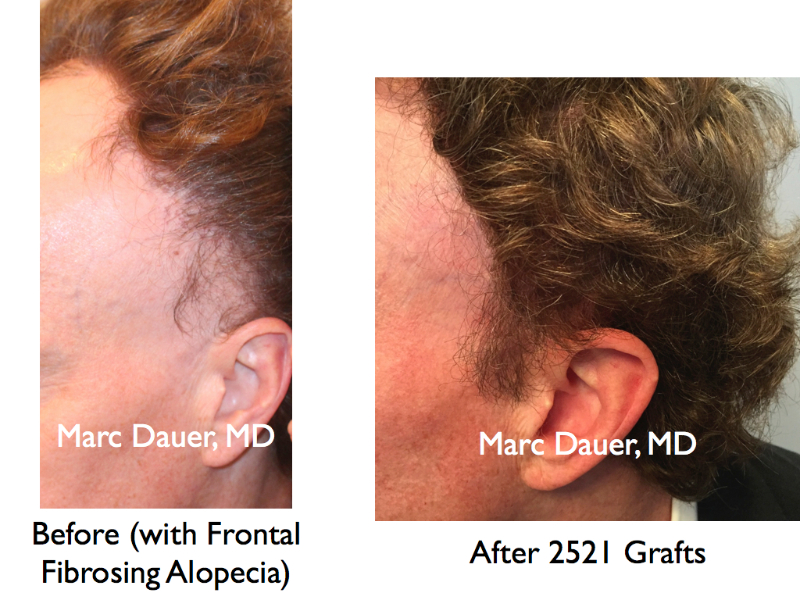 Female Hair Transplant Results Hair Transplant Los Angeles, Eyebrow