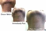 donor site of FUE extractions for mustache hair transplant donor site of FUE extractions for mustache hair transplant