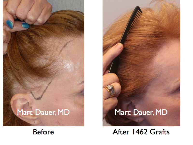 Before And After Female Hair Transplant Marc Dauer Md