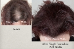 Before and After hair transplant of Women Before and After hair transplant of Women