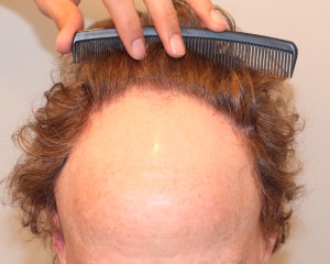 Lichen Planopilaris of the scalp.