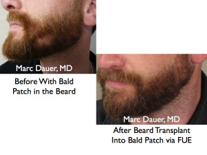 Beard Transplant via FUE