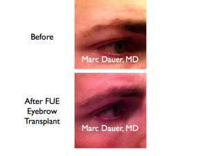 This is a male patient who had an eyebrow transplant harvested via FUE.