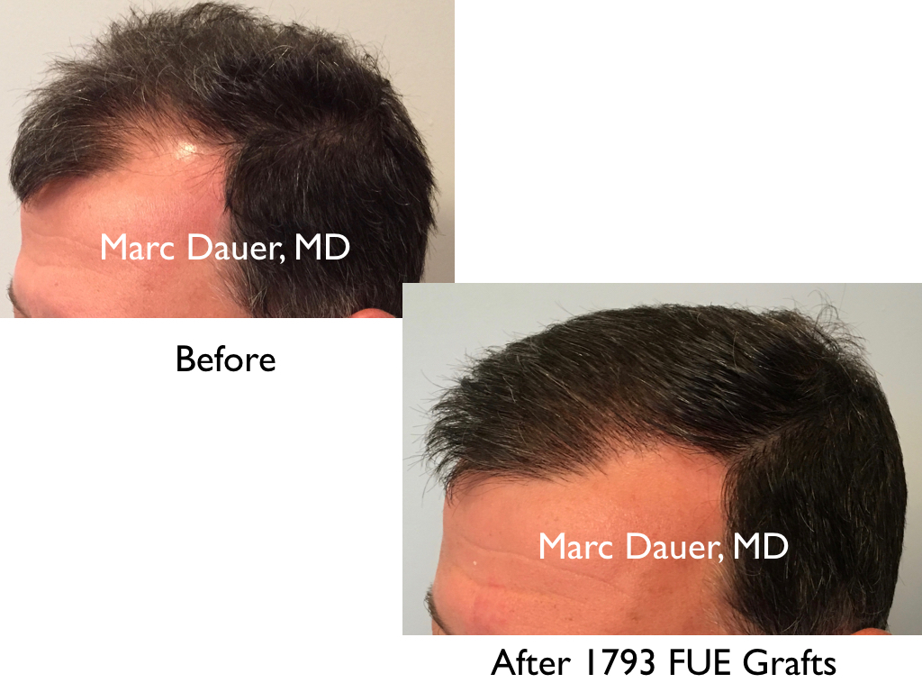 Fue Hair Transplant Result Marc Dauer Md Hair Transplant Doctor Los