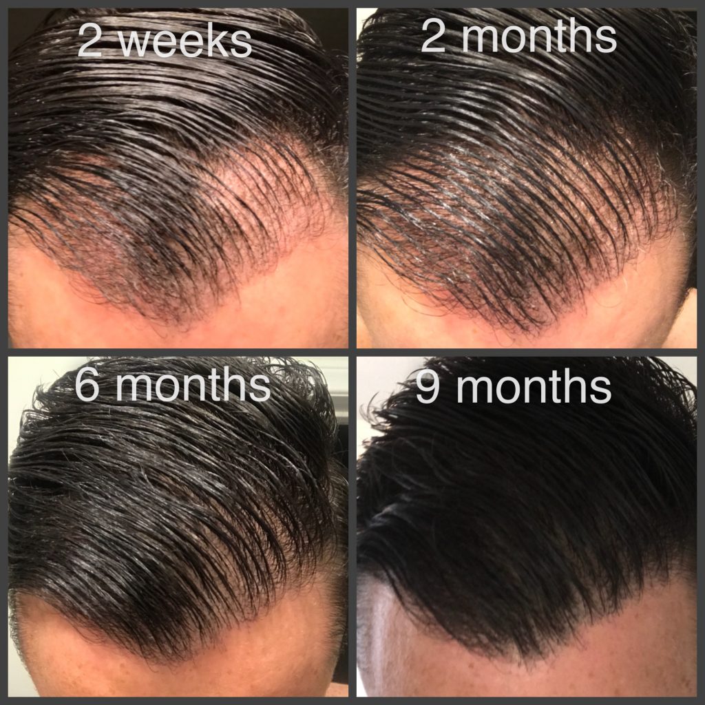 Collection of 2 Month Post Op Fue Hair Transplant | Bhr Hair Transplant
