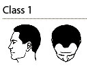 male hair transplantation