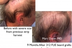 beard hair transplant into strip scar