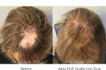 hair transplant into scalp scar