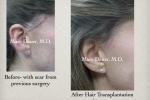 Hair Transplant for Scars