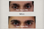 Eyebrow Loss Restored with Eyebrow Transplant for men