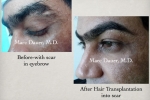 eyebrow transplantation - men