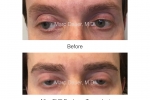 eyebrow transplant photos