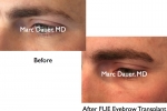 Male Eyebrow Transplant Photos