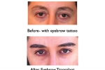 Eyebrow Transplant Surgeon