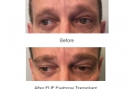 eyebrow transplant photos