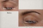 Eyebrow Transplant, Eyebrow Restoration