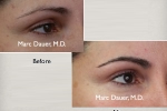 Before and after (below) eyebrow hair transplantation