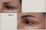 Before (above) and after (below) eyebrow hair transplantation