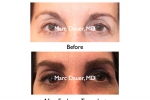 female eyebrow transplant photos