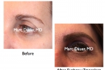 female eyebrow transplant photos