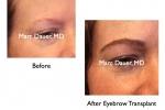 Before and After Eyebrow Transplant Photos