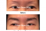before and after eyebrow transplant photos
