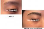 eyebrow transplant before and after photos