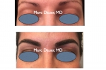 before and after eyebrow transplant photos