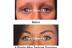 eyebrow transplant photo