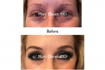 eyebrow transplants before and after photos