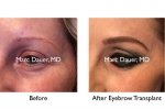 eyebrow transplants before and after photos