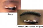 Eyebrow Transplants & Restoration