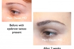 Eyebrow Transplants & Restoration