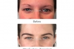 Eyebrow Transplant Photos 