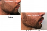 beard FUE hair transplant