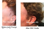 hair transplant to sideburns
