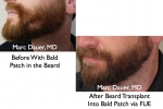 Beard Hair Transplant