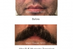 mustache fue hair transplant