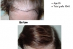 Before and After hair transplant Images