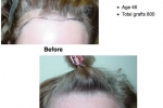 Women Before and After hair transplant Women Before and After hair transplant