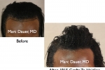 Before and After hair transplant Pictures