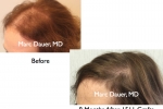 female hair transplant photos