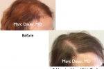 female hair transplant photos