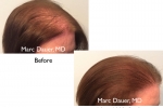 before and after female hair transplant photos