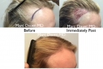 before and after female hair transplant photos