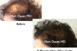 Female Before and After hair transplant