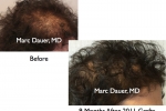 Female Before and After hair transplant