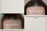 Eyebrow Restoration Procedure